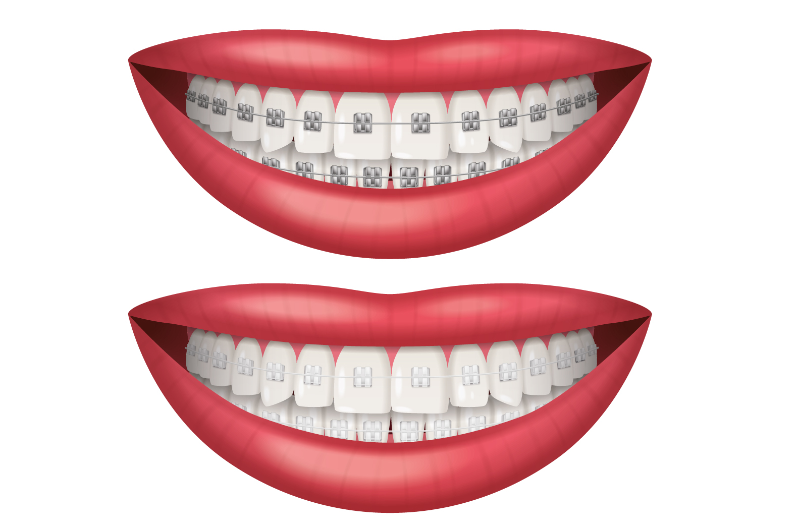 Các loại mắc cài phổ biến hiện nay