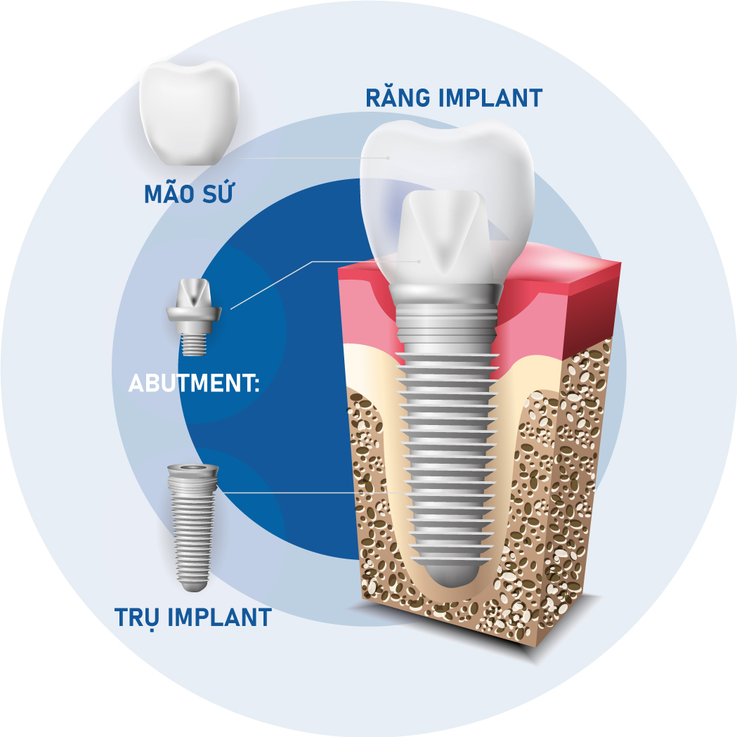 Cấu tạo của Implant  Cấu tạo của Implant