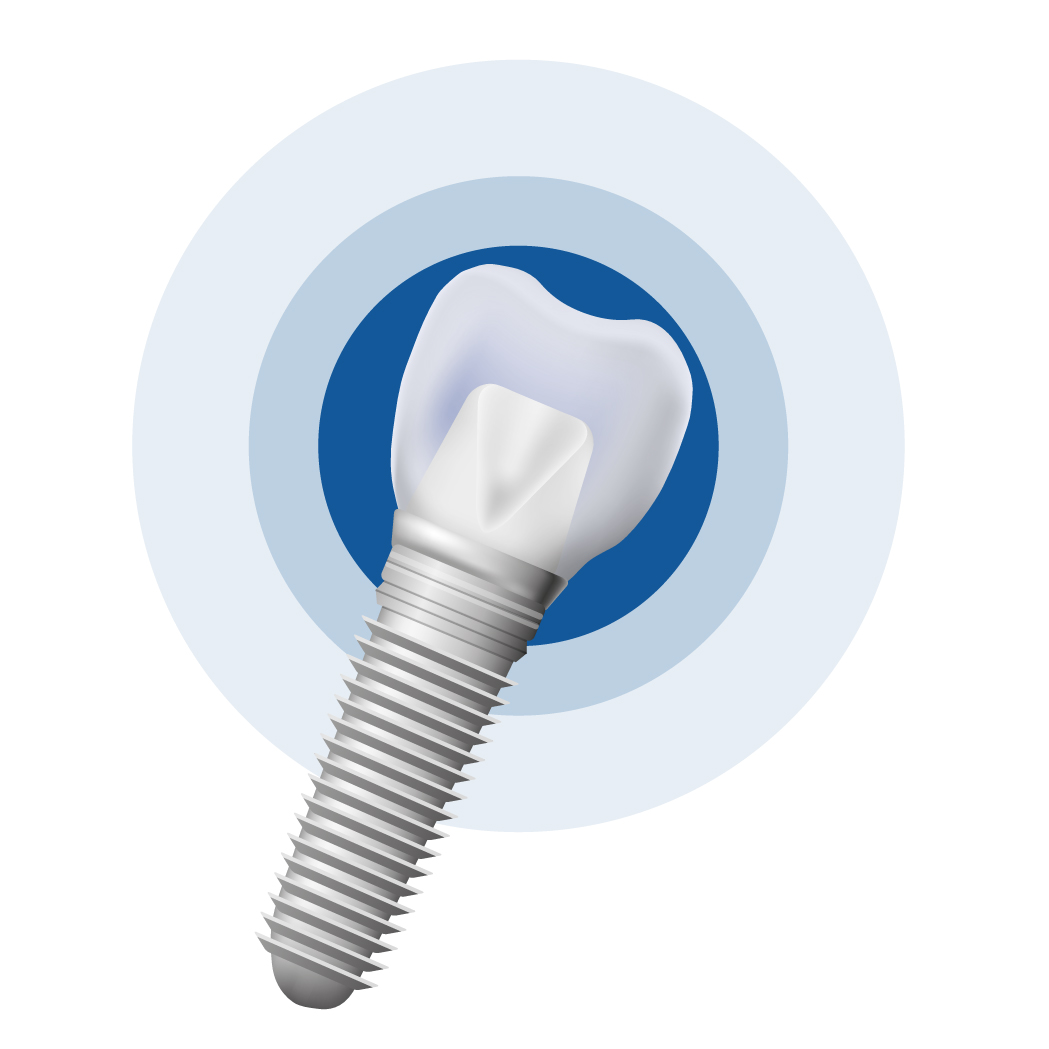 Có bao nhiêu loại Implant?  Có bao nhiêu loại Implant?