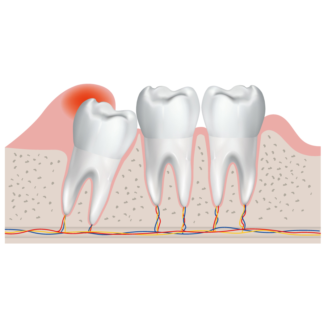 Dấu hiệu nhận biết và độ tuổi mọc răng khôn phổ biến