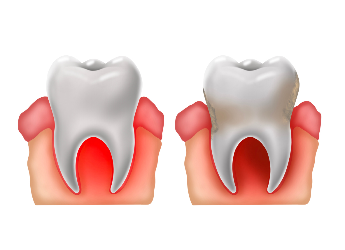 Dấu hiệu nhận biết viêm nha chu   Dấu hiệu nhận biết viêm nha chu