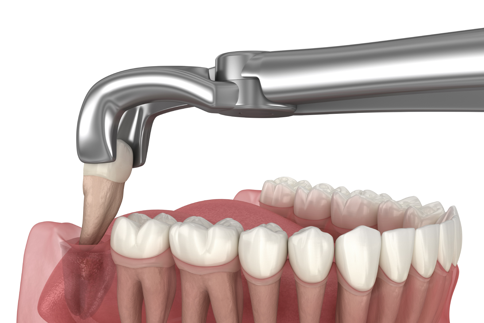 Nhổ răng khôn có nguy hiểm không?