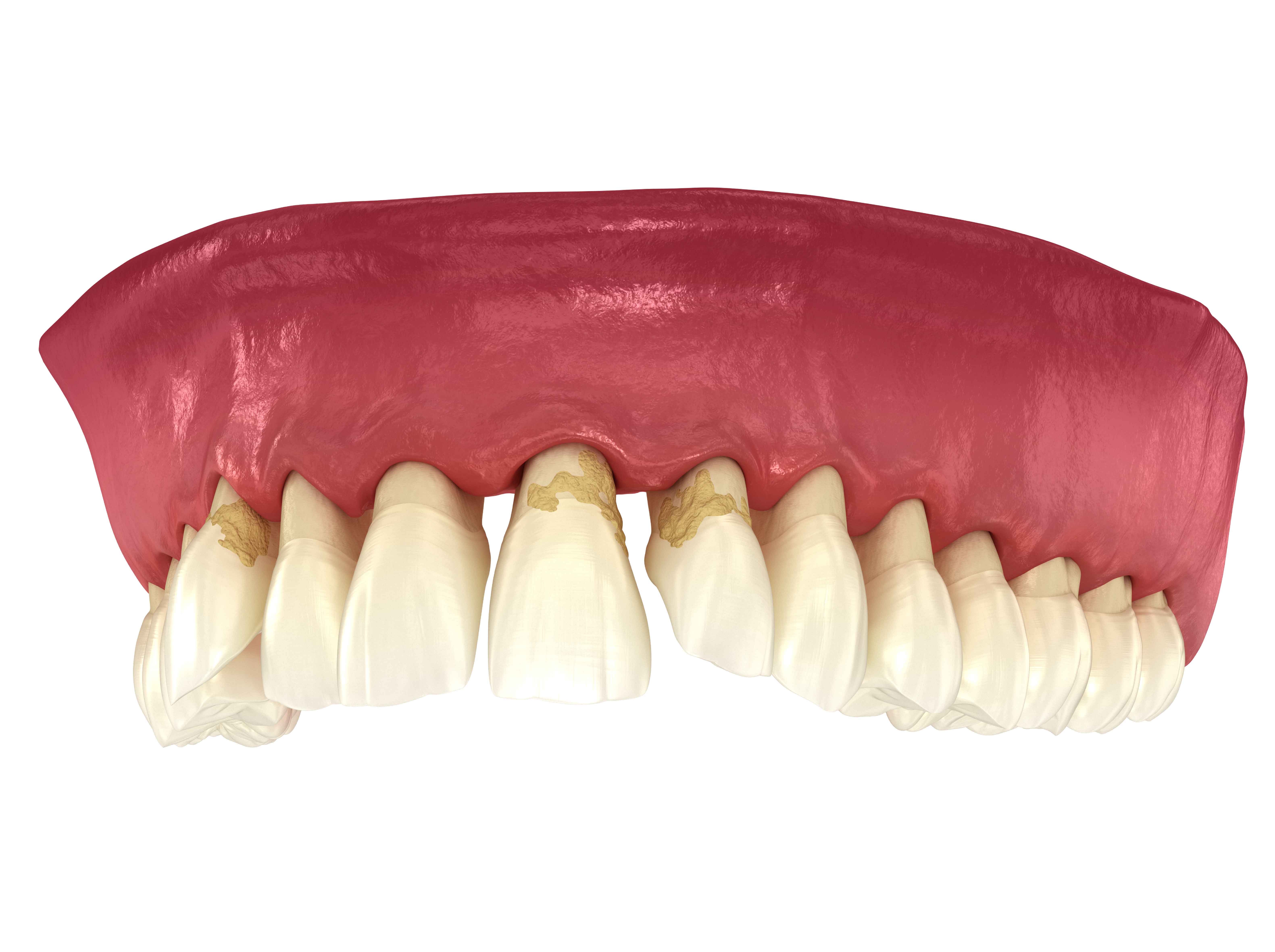 Viêm nha chu là gì? Viêm nha chu là gì?