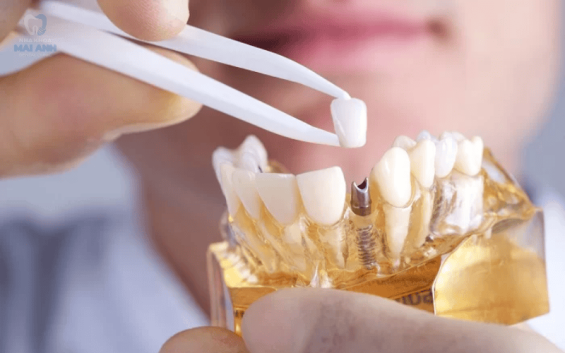 Bảng giá trồng răng Implant tại Nha khoa Mai Anh - Có nên trồng răng Implant không?