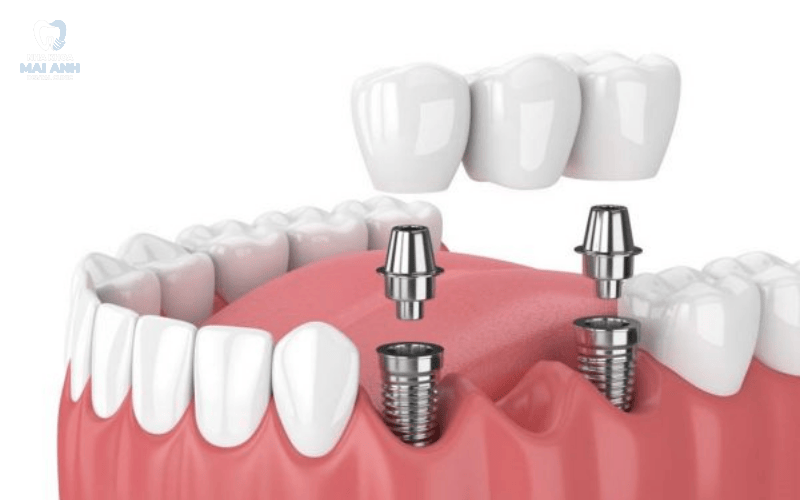 Trồng răng Implant - giải pháp lý tưởng cho người mất răng Trồng răng Implant - giải pháp lý tưởng cho người mất răng