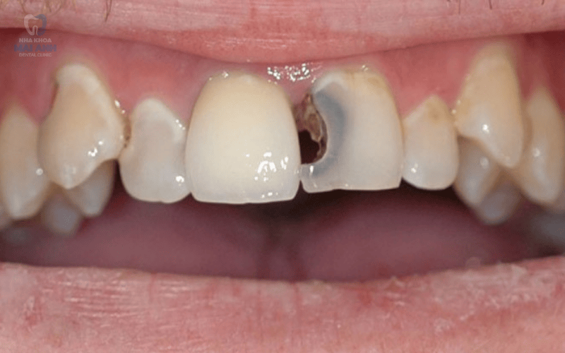 Mất răng cửa nên xử lý như thế nào? Giải pháp phục hình hiệu quả từ Nha khoa Mai Anh Mất răng cửa nên xử lý như thế nào? Giải pháp phục hình hiệu quả từ Nha khoa Mai Anh