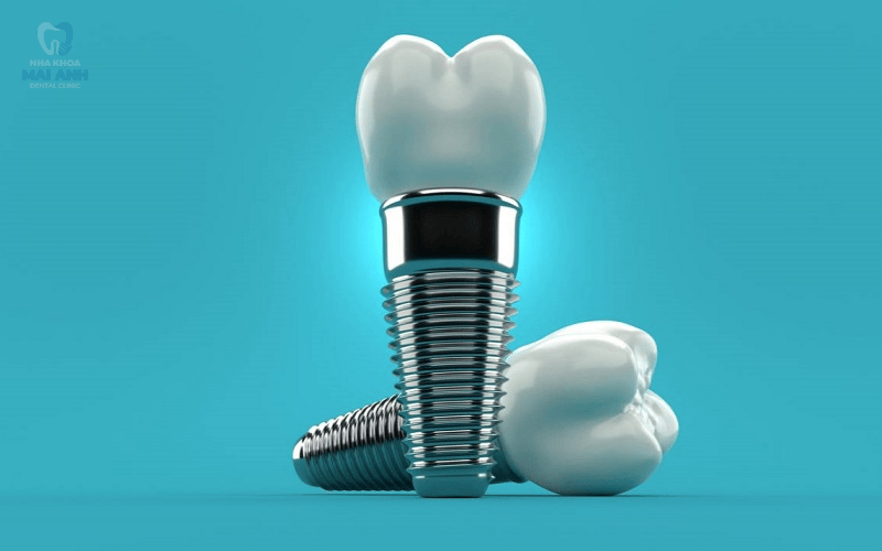 Những điều cần biết trước khi cấy răng implant Những điều cần biết trước khi cấy răng implant
