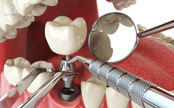 Cắm Implant và những điều cần biết