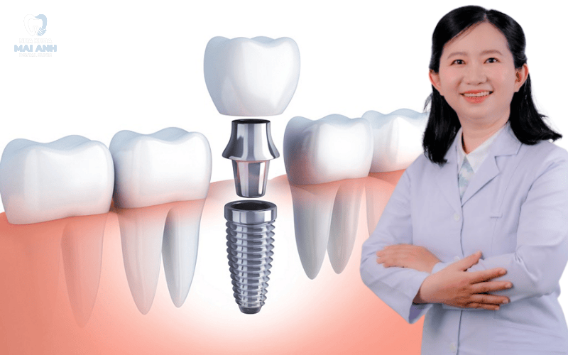 Cần lưu ý gì sau khi trồng răng implant toàn hàm?
