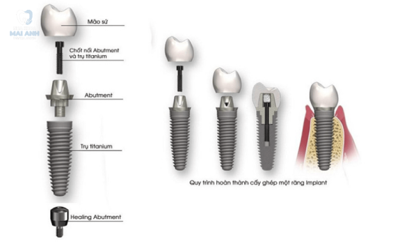 Những điều cần biết trước khi cấy răng implant