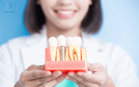 Cấy ghép Implant mất bao lâu - Khi nào thì hồi phục hoàn toàn