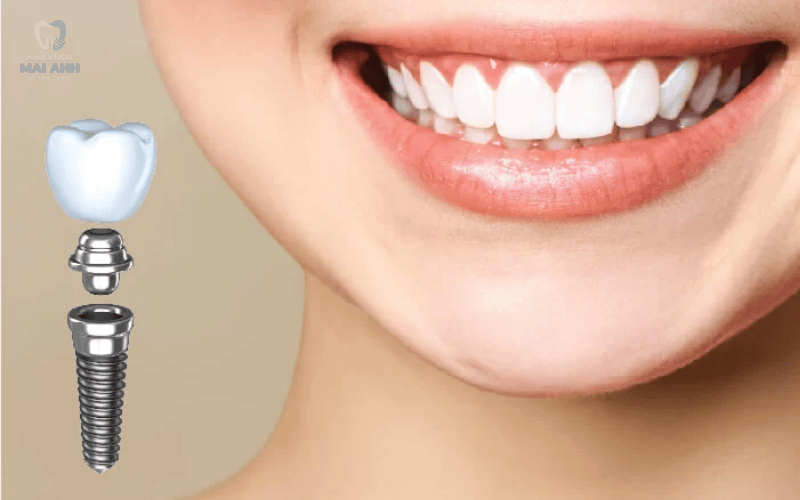 Quy trình cấy ghép Implant tại Nha khoa Mai Anh Quy trình cấy ghép Implant tại Nha khoa Mai Anh