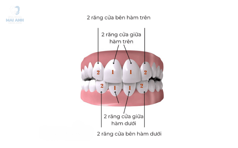 Nguyên nhân gì gây mất răng cửa? Nên phòng ngừa mất răng cửa như thế nào? Nguyên nhân gì gây mất răng cửa? Nên phòng ngừa mất răng cửa như thế nào?
