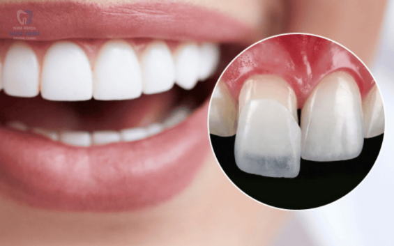 5 Điều cần lưu ý trước khi dán sứ Veneer để có nụ cười hoàn hảo