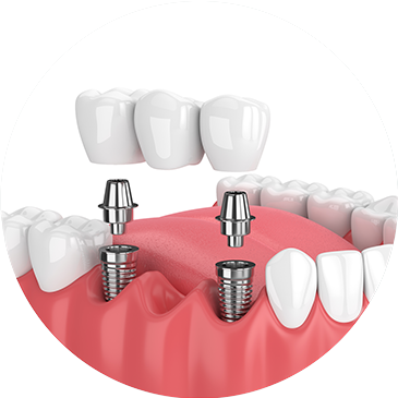 Trồng răng Implant