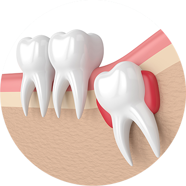 Tiểu phẫu răng khôn
