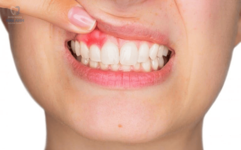 Hậu quả mất răng hàm có nghiêm trọng không? Hậu quả mất răng hàm có nghiêm trọng không?