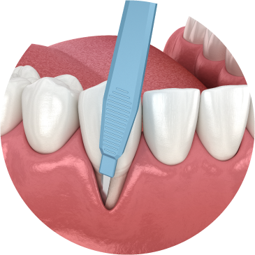 Phẫu thuật nha chu