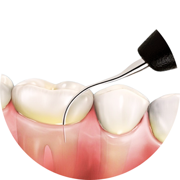 Phẫu thuật nha chu