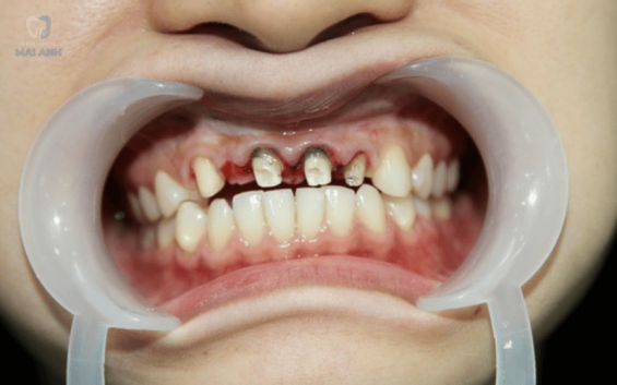 Giá răng sứ titan là bao nhiêu? Những điều cần biết trước khi bọc răng sứ titan