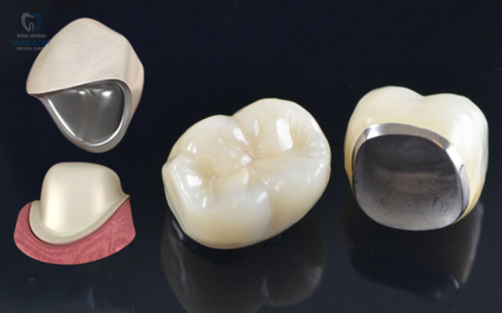 Giá trồng răng sứ Titan rẻ nhất 2025 tại quận Gò Vấp