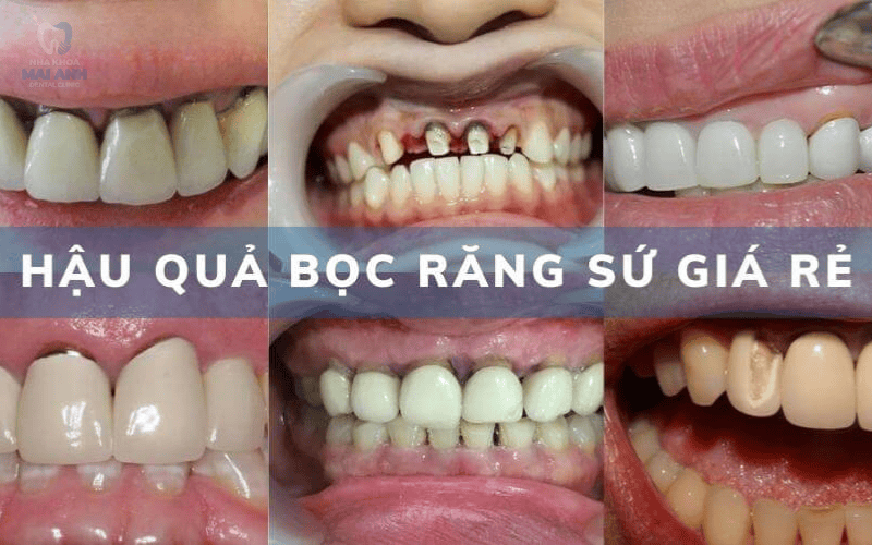 Hậu quả bọc răng sứ giá rẻ Hậu quả bọc răng sứ giá rẻ