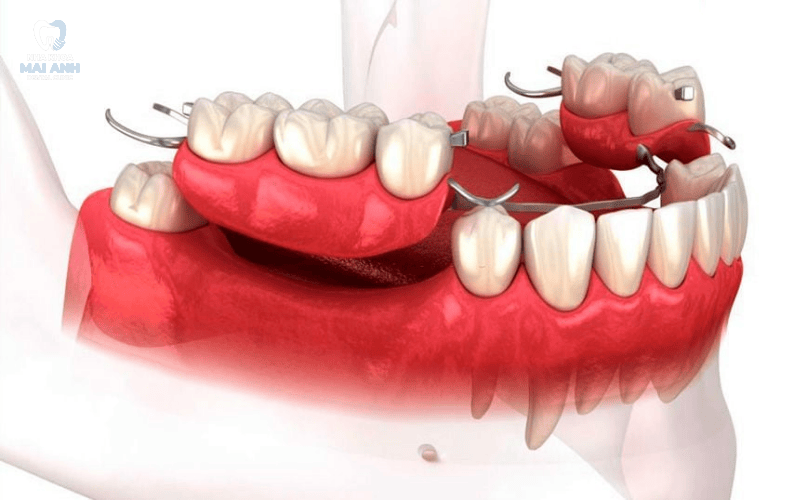 Mất răng cửa nên xử lý như thế nào? Giải pháp phục hình hiệu quả từ Nha khoa Mai Anh Mất răng cửa nên xử lý như thế nào? Giải pháp phục hình hiệu quả từ Nha khoa Mai Anh