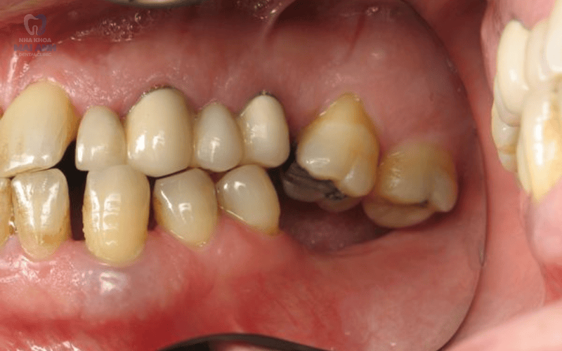 Hậu quả của mất răng cửa lâu ngày Hậu quả của mất răng cửa lâu ngày