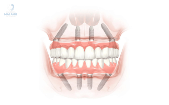 Trồng răng nguyên hàm ở đâu an toàn, uy tín tại quận Gò Vấp?