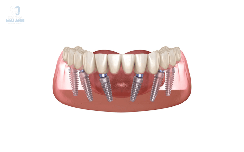 Trồng răng nguyên hàm ở đâu an toàn, uy tín tại quận Gò Vấp? Trồng răng nguyên hàm ở đâu an toàn, uy tín tại quận Gò Vấp?