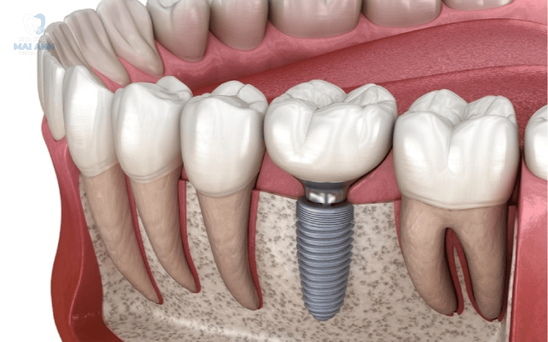 Những điều cần biết trước khi cấy răng implant Những điều cần biết trước khi cấy răng implant