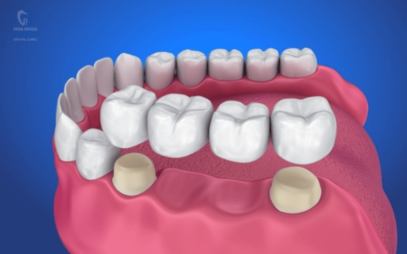 Mất răng cửa nên xử lý như thế nào? Giải pháp phục hình hiệu quả từ Nha khoa Mai Anh Mất răng cửa nên xử lý như thế nào? Giải pháp phục hình hiệu quả từ Nha khoa Mai Anh