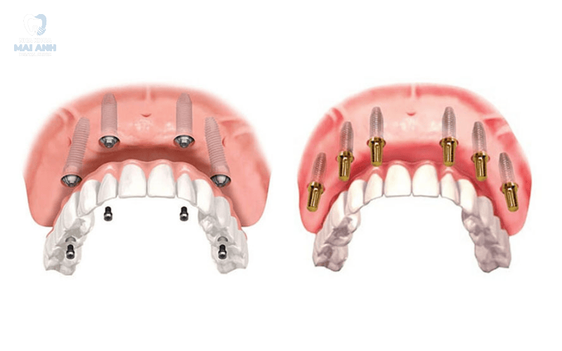 Làm răng implant toàn hàm - giải pháp khôi phục nụ cười vững bền tại nha khoa Mai Anh Làm răng implant toàn hàm - giải pháp khôi phục nụ cười vững bền tại nha khoa Mai Anh