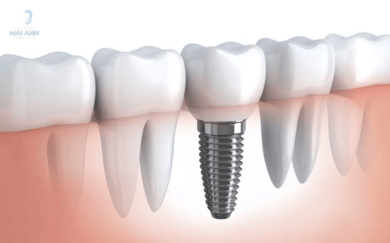 Làm răng implant toàn hàm - giải pháp khôi phục nụ cười vững bền tại nha khoa Mai Anh