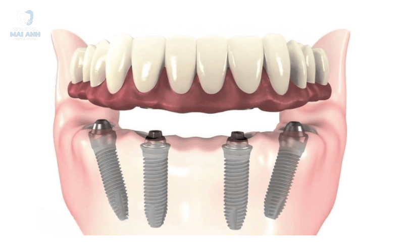 Làm răng implant toàn hàm - giải pháp khôi phục nụ cười vững bền tại nha khoa Mai Anh Làm răng implant toàn hàm - giải pháp khôi phục nụ cười vững bền tại nha khoa Mai Anh