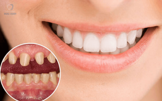 Làm răng sứ có tốt không? Duy trì được bao lâu?