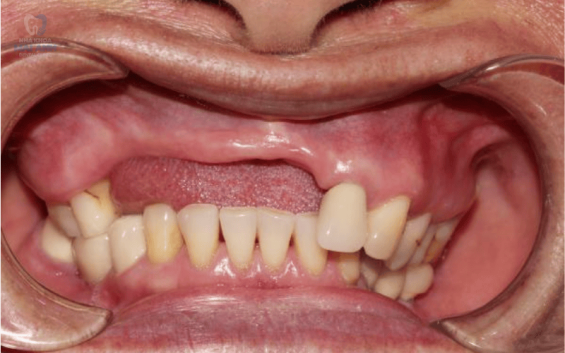 Mất răng bao lâu thì bị tiêu xương hàm? Nên khắc phục như thế nào?