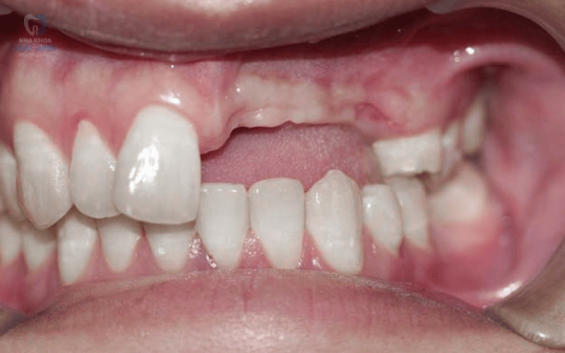 Trồng răng cửa cần chú ý những điều gì?