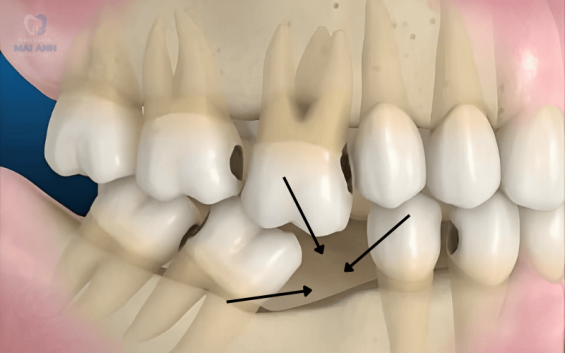 Mất răng hàm dưới nên phục hình như thế nào?