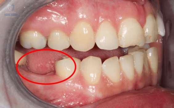 Mất răng số 6 có nguy hiểm gì không? Mất răng số 6 có nguy hiểm gì không?