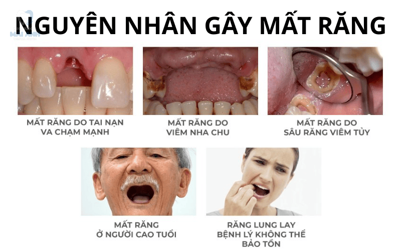 Nguyên nhân gì gây mất răng cửa? Nên phòng ngừa mất răng cửa như thế nào? Nguyên nhân gì gây mất răng cửa? Nên phòng ngừa mất răng cửa như thế nào?