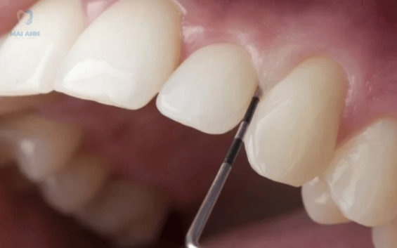 Nha khoa trên đường Nguyễn Văn Công làm răng sứ đẹp – Lựa chọn hoàn hảo cho nụ cười rạng rỡ