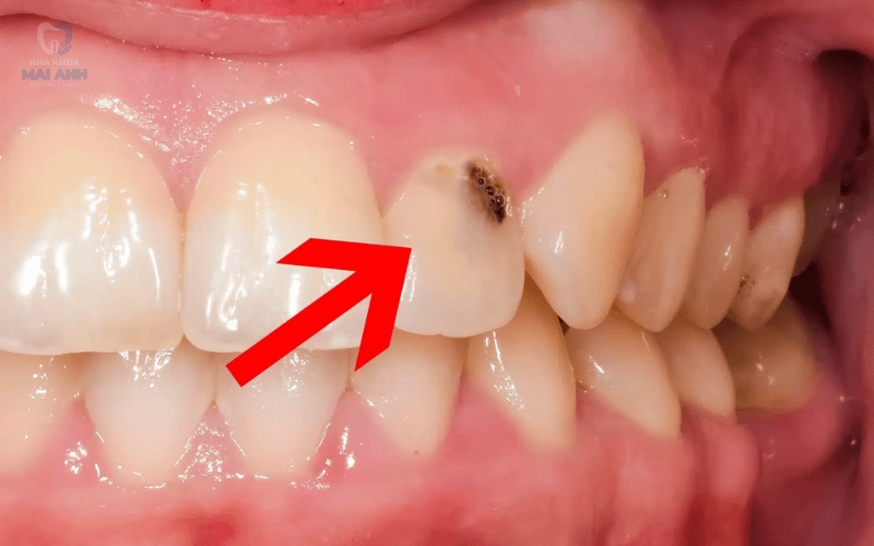 Nguyên nhân gì gây mất răng cửa? Nên phòng ngừa mất răng cửa như thế nào? Nguyên nhân gì gây mất răng cửa? Nên phòng ngừa mất răng cửa như thế nào?