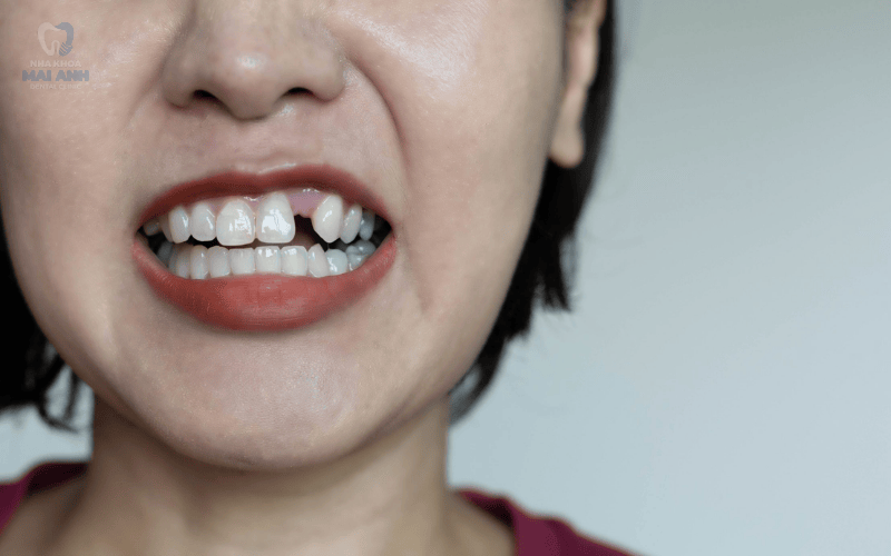 Những nguyên nhân phổ biến gây mất răng cửa Những nguyên nhân phổ biến gây mất răng cửa