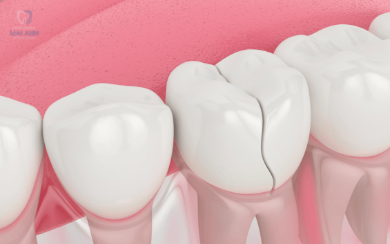 Những tác hại cần biết trước khi làm răng sứ thẩm mỹ