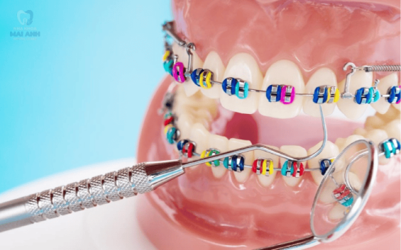 Niềng răng mắc cài tại Gò Vấp - Đâu là cơ sở uy tín, chất lượng?