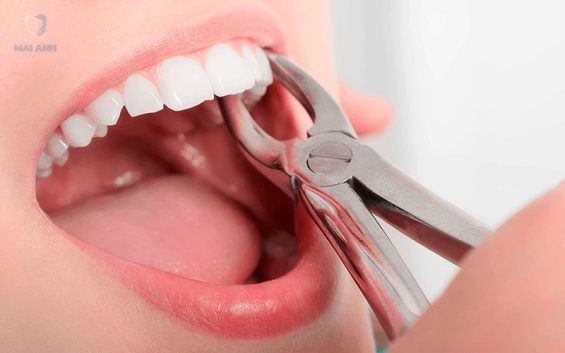 Bật mí Nha khoa chuyên nhổ răng khôn tại Gò Vấp uy tín, chất lượng Bật mí Nha khoa chuyên nhổ răng khôn tại Gò Vấp uy tín, chất lượng