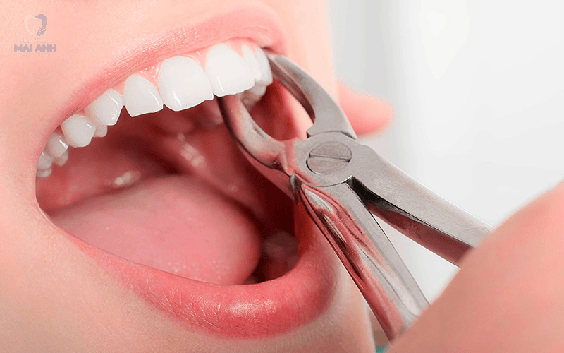 Quy trình nhổ răng khôn tại Nha khoa Mai Anh Quy trình nhổ răng khôn tại Nha khoa Mai Anh