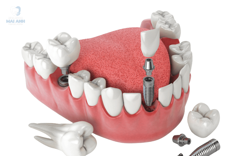 Răng cửa có trồng implant được không Răng cửa có trồng implant được không