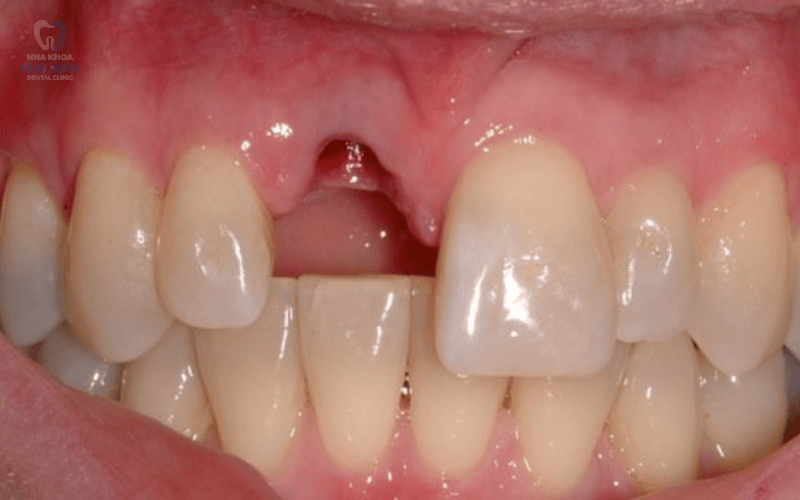 Mất răng cửa nên xử lý như thế nào? Giải pháp phục hình hiệu quả từ Nha khoa Mai Anh Mất răng cửa nên xử lý như thế nào? Giải pháp phục hình hiệu quả từ Nha khoa Mai Anh